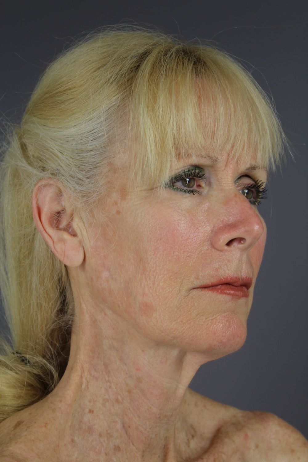 Face Lift Before & After