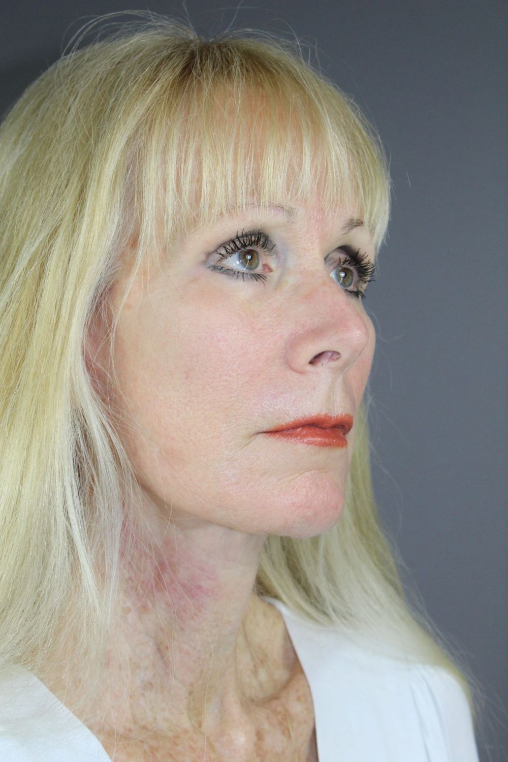 Face Lift Before & After