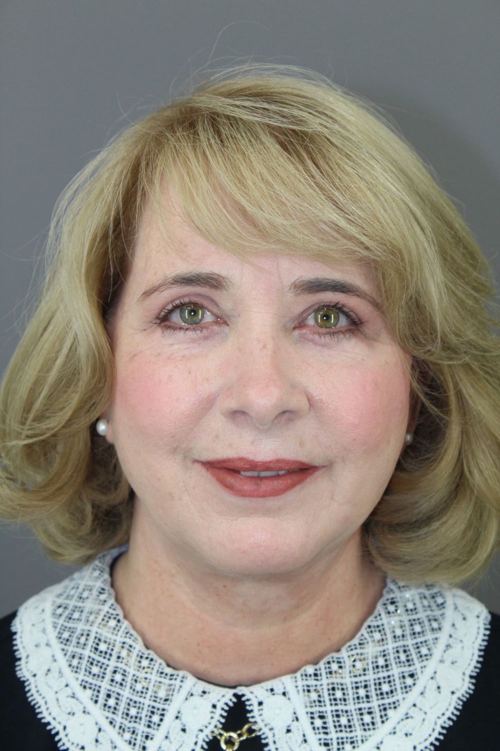 Face Lift Before & After