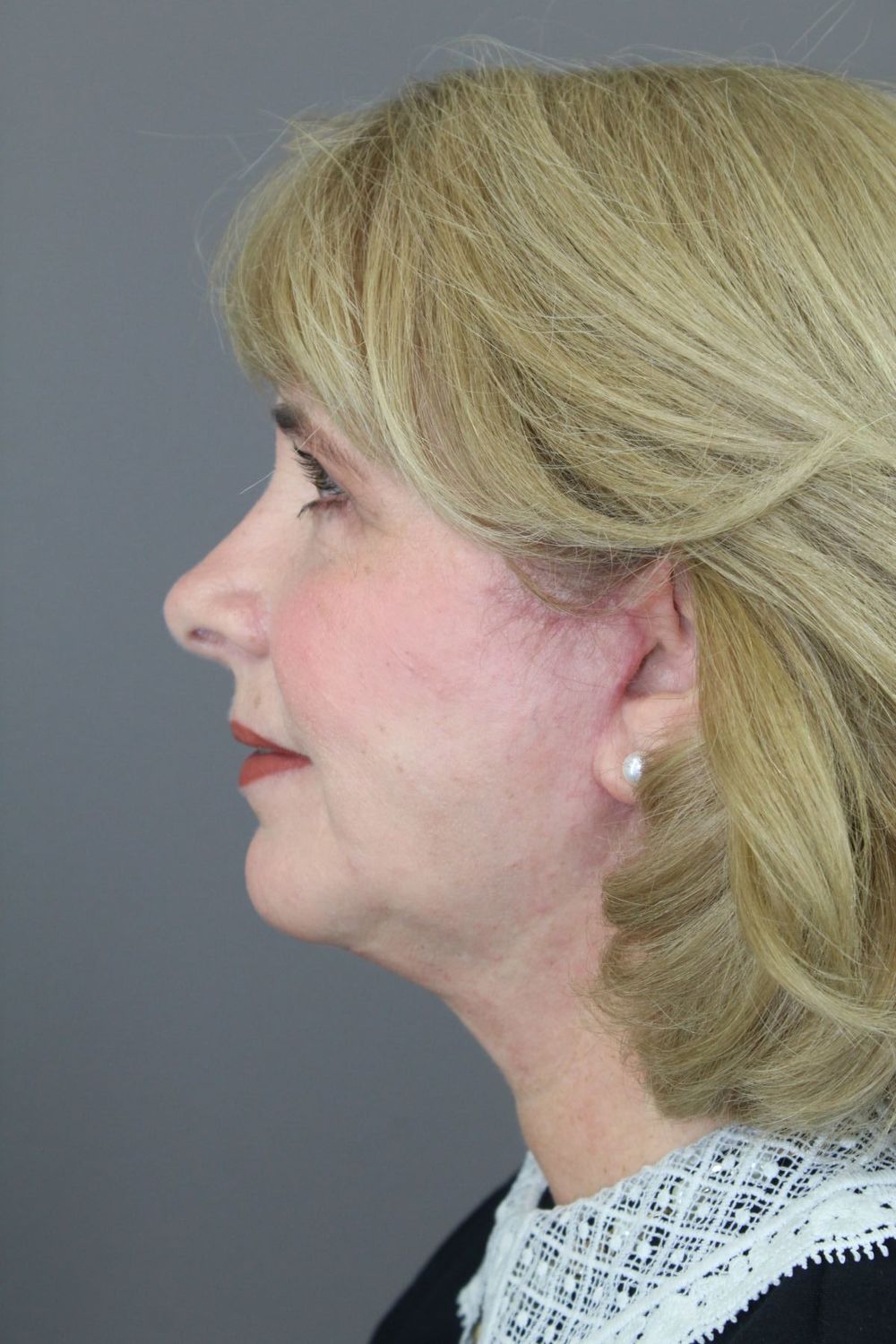 Face Lift Before & After