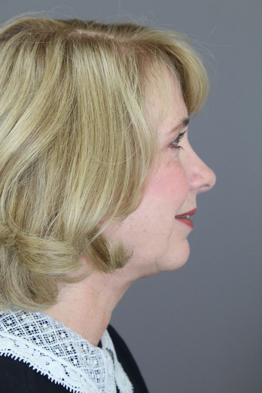 Face Lift Before & After