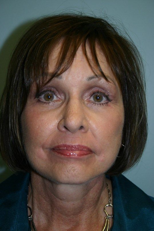 Face Lift Before & After