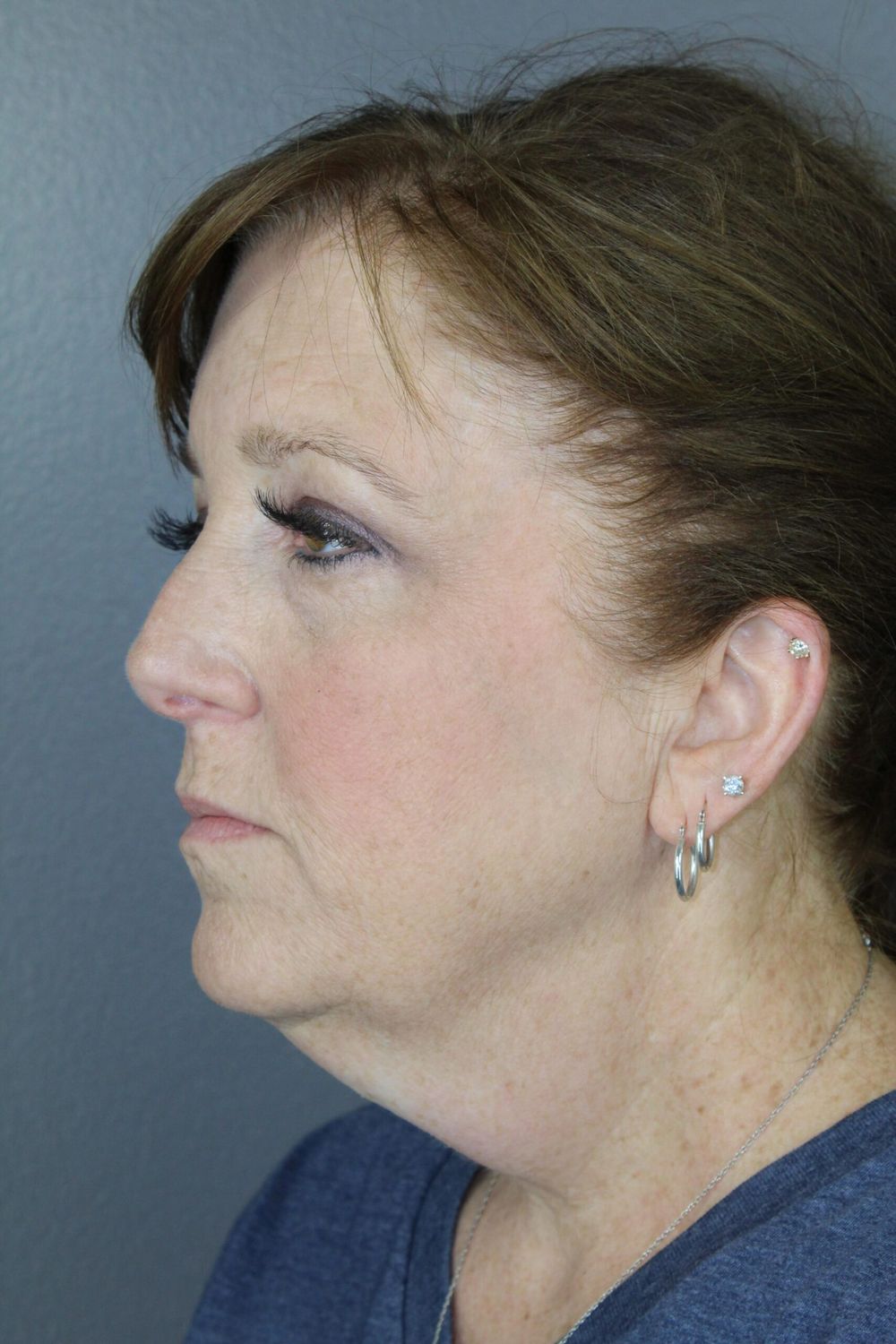 Face Lift Before & After