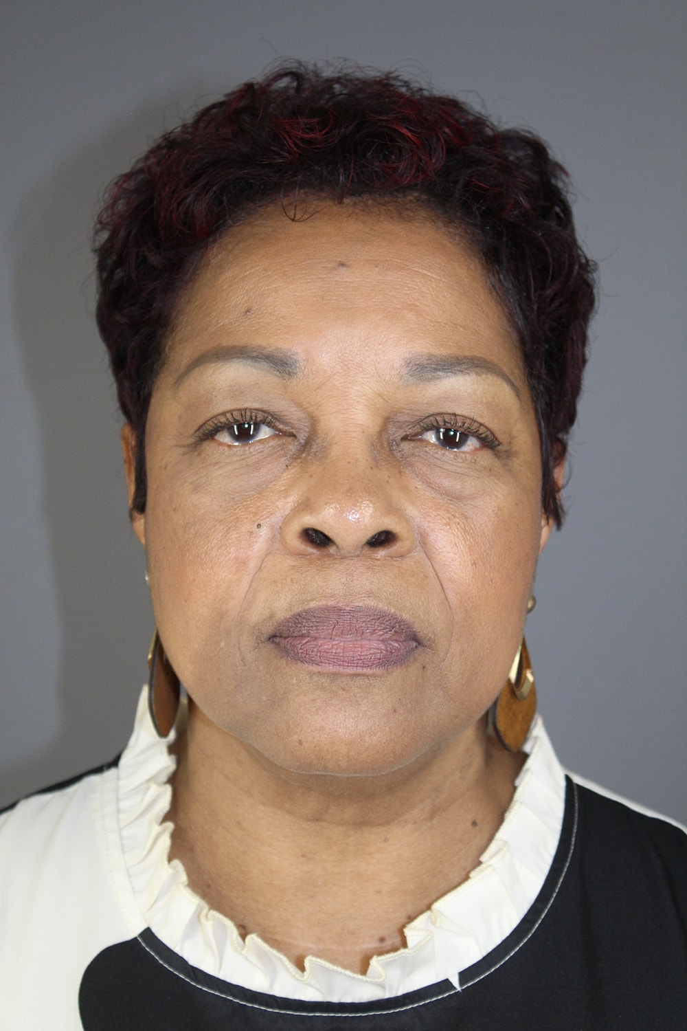 Face Lift Before & After