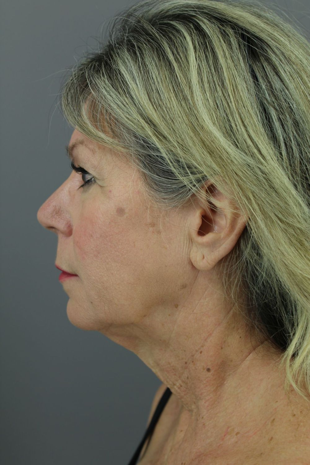 Face Lift Before & After