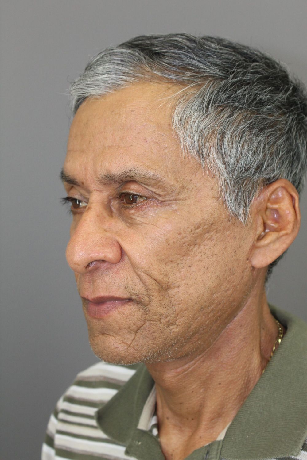 Face Lift Before & After