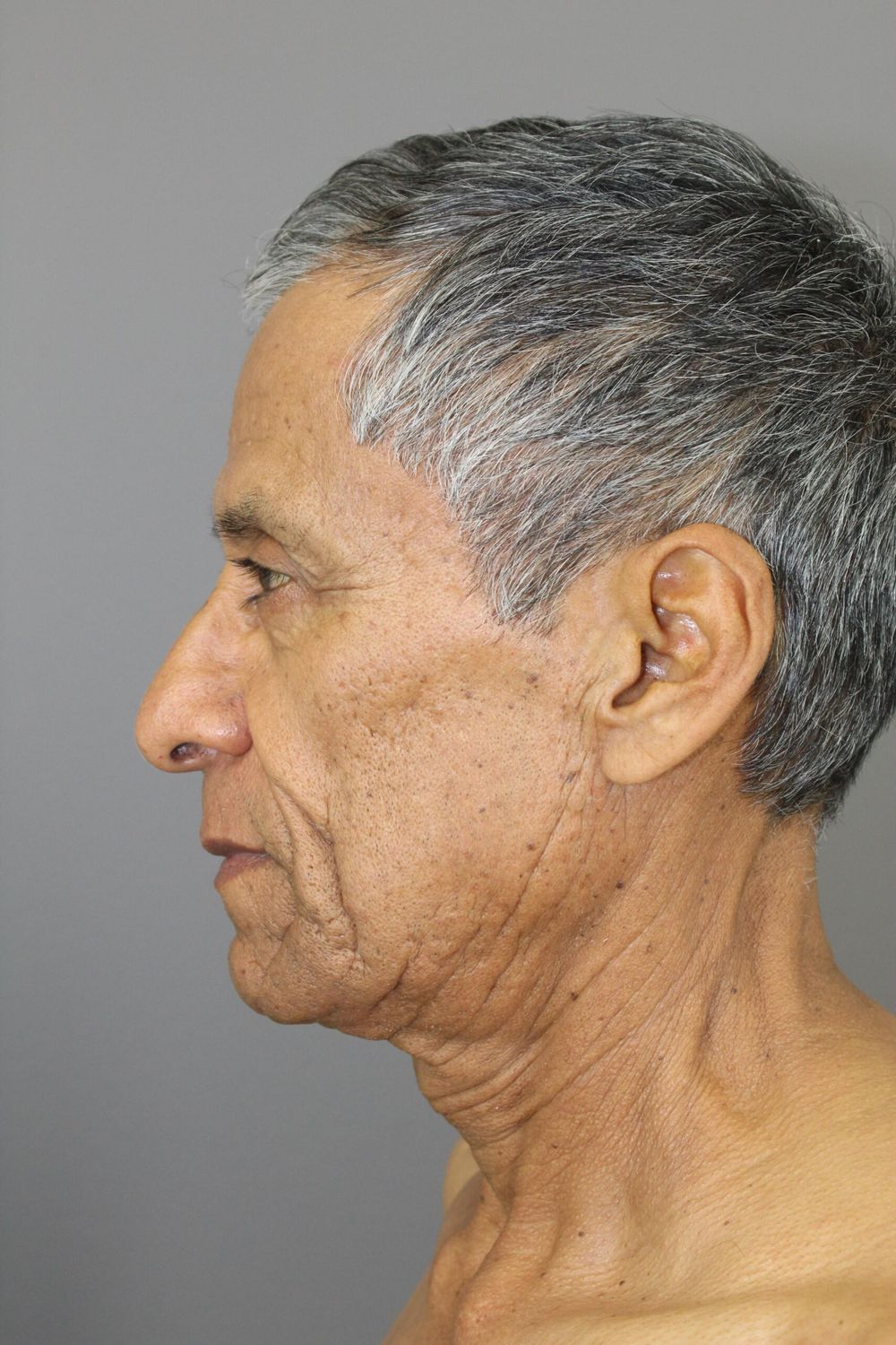 Face Lift Before & After