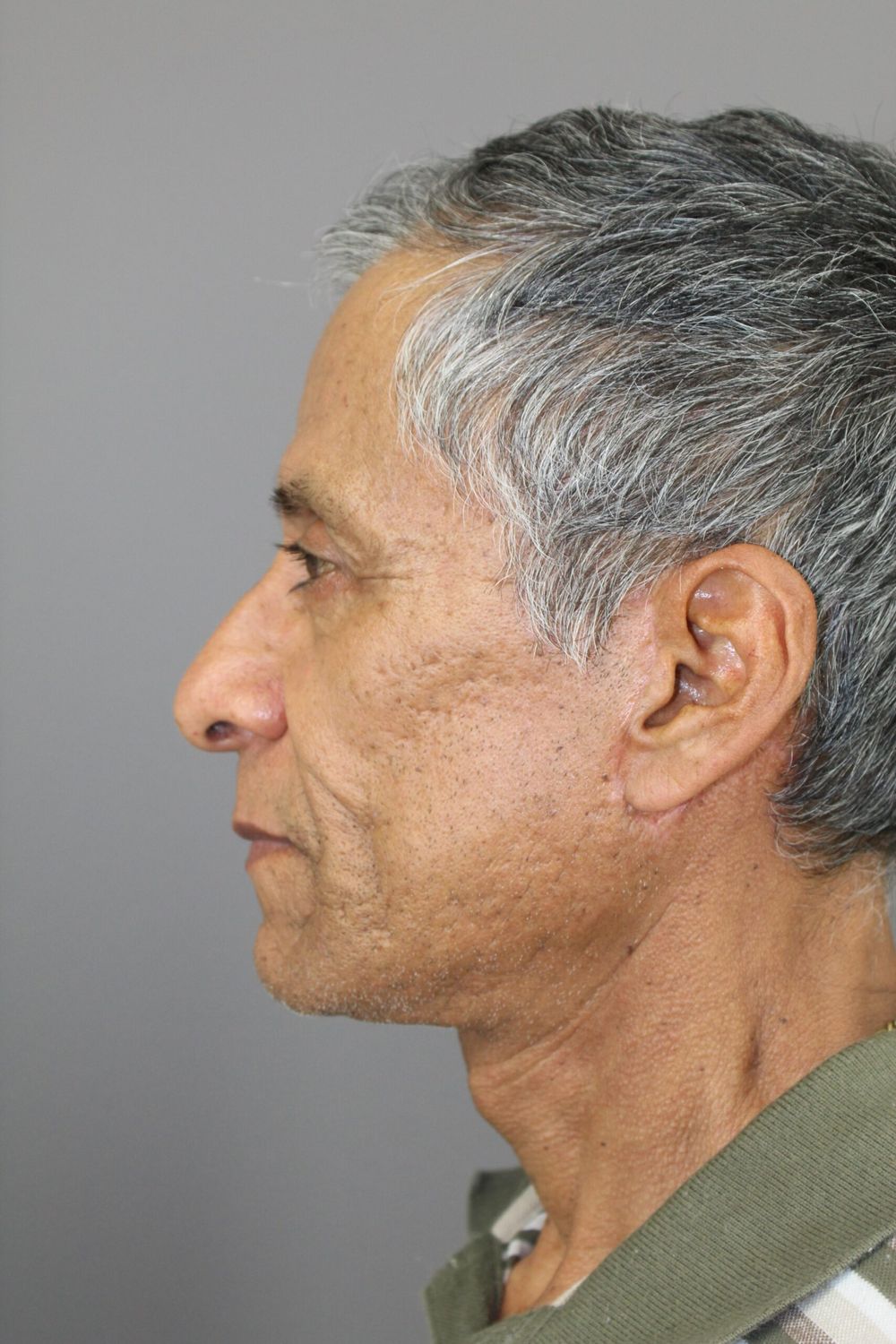 Face Lift Before & After