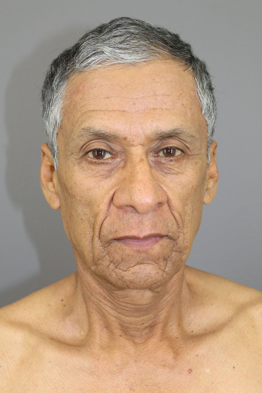 Face Lift Before & After