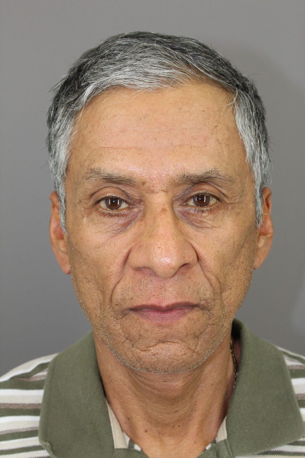 Face Lift Before & After