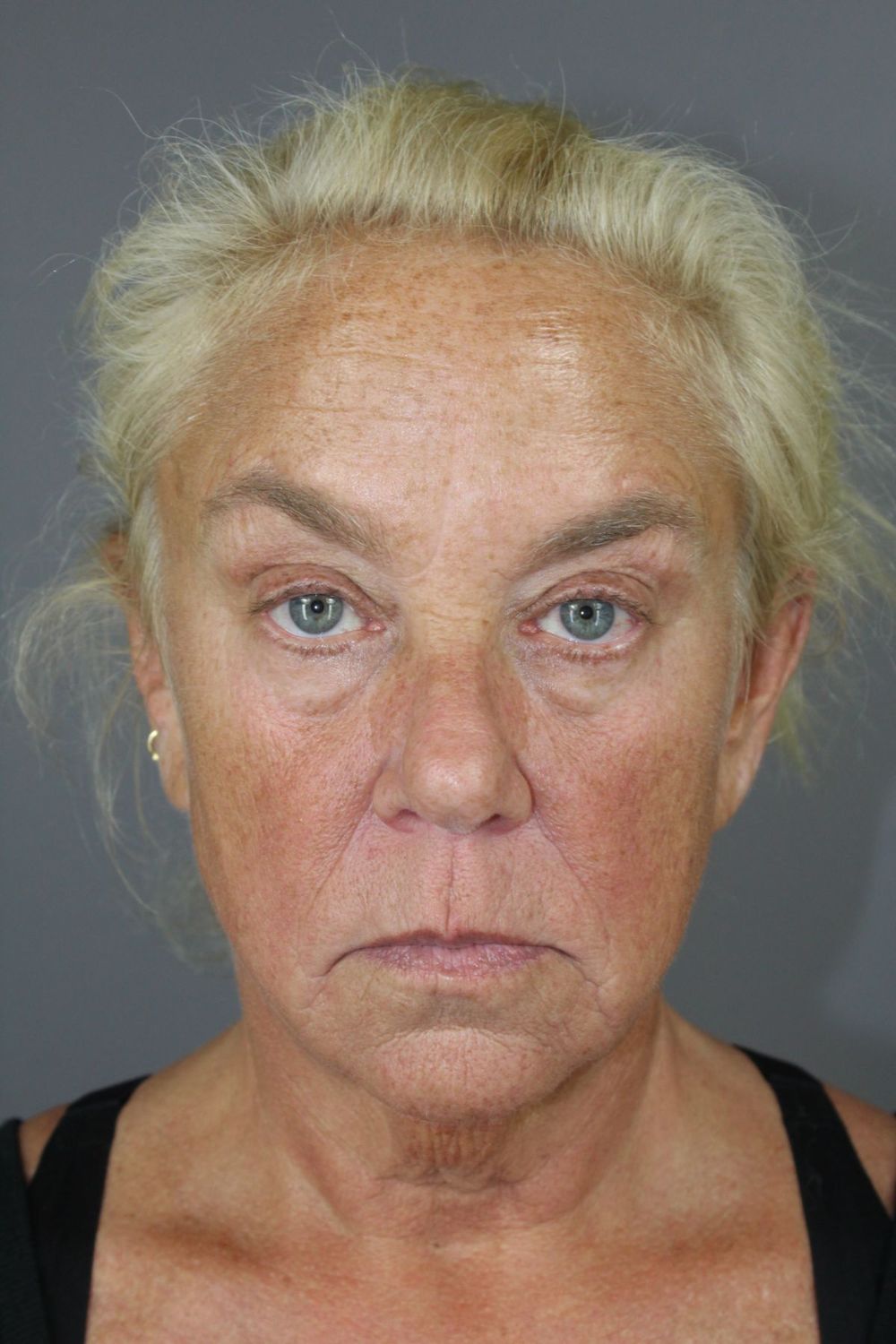 Face Lift Before & After