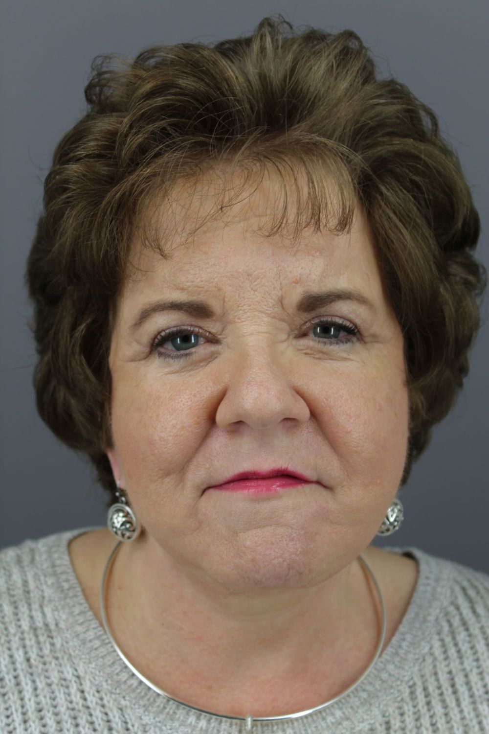 Face Lift Before & After