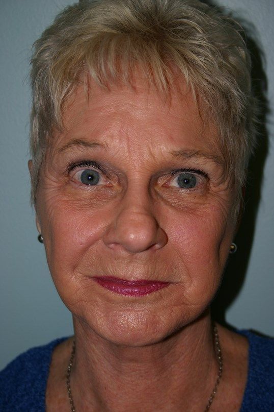 Face Lift Before & After