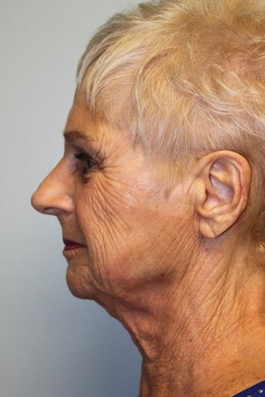 Face Lift Before & After