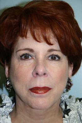 Face Lift Before & After