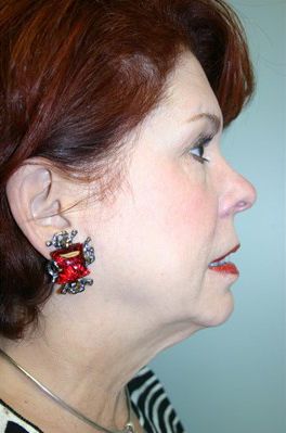 Face Lift Before & After