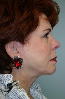 Face Lift Before & After