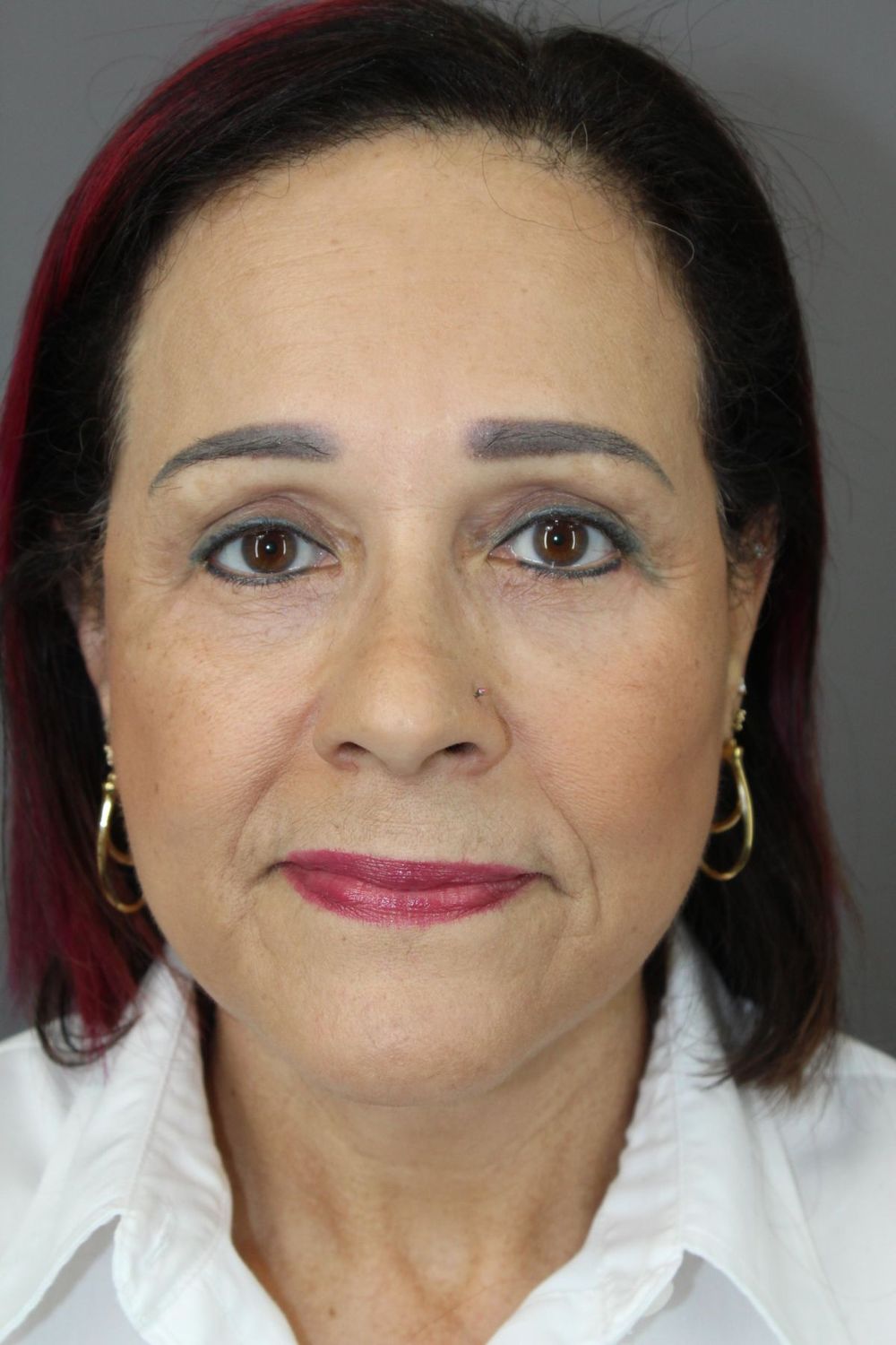 Face Lift Before & After