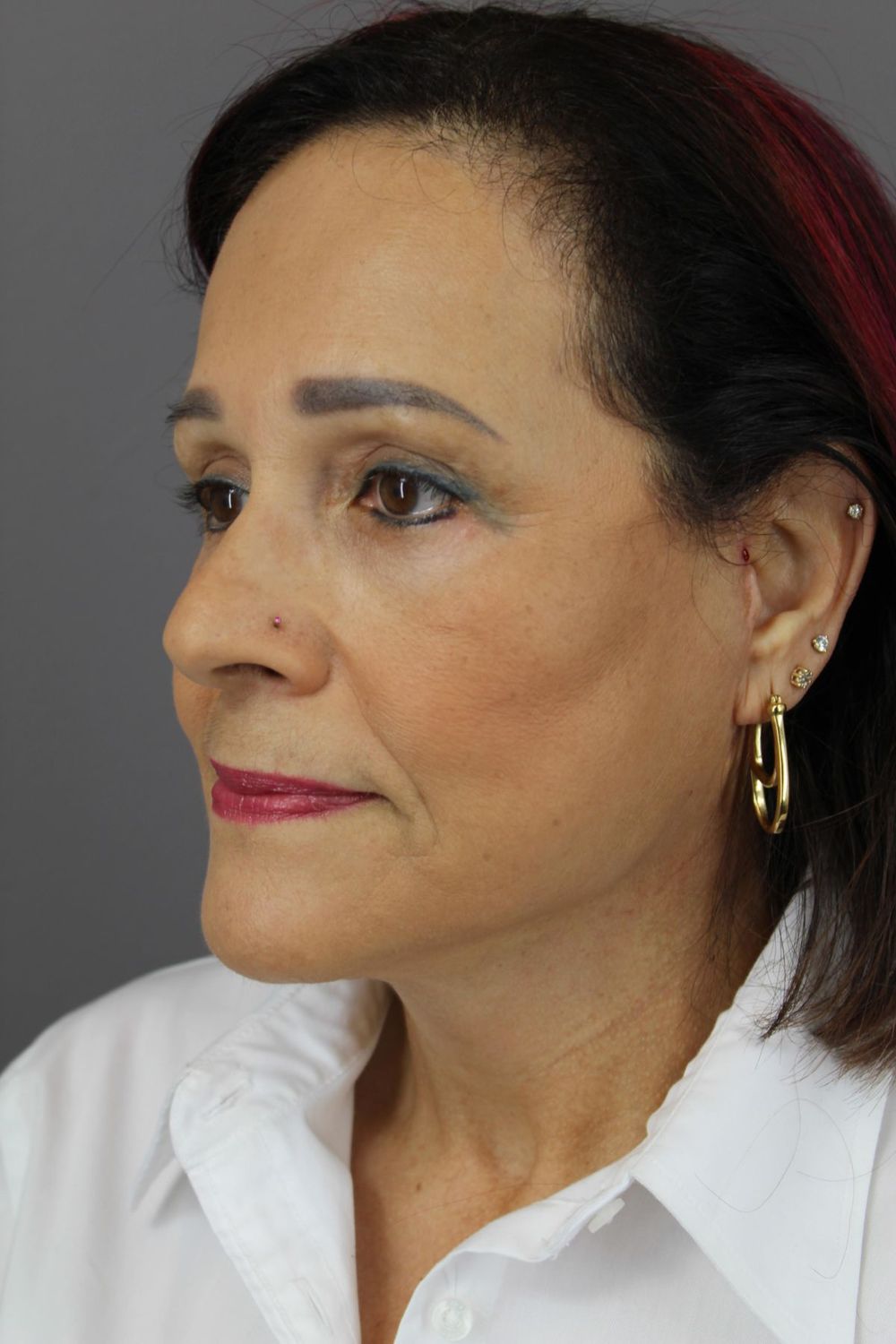 Face Lift Before & After