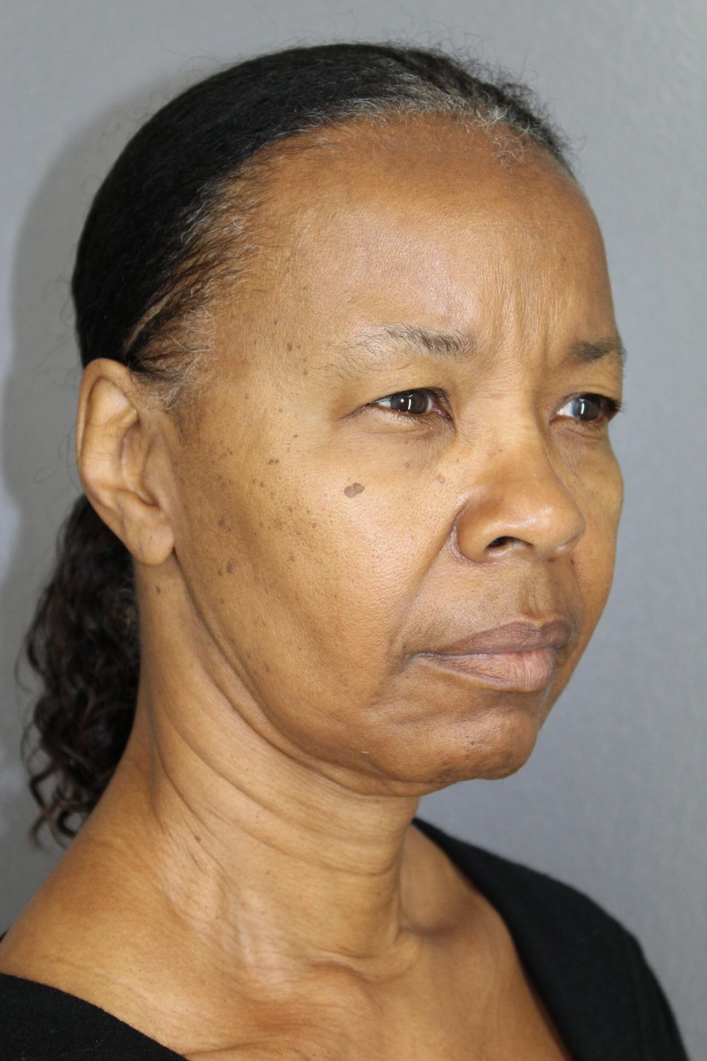 Face Lift Before & After