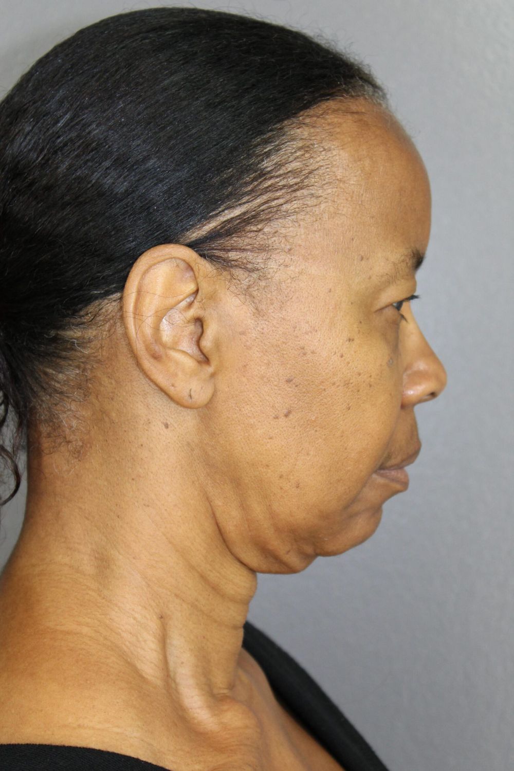 Face Lift Before & After