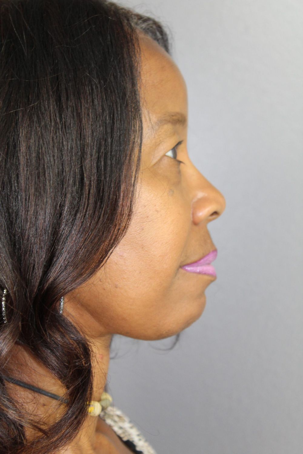 Face Lift Before & After