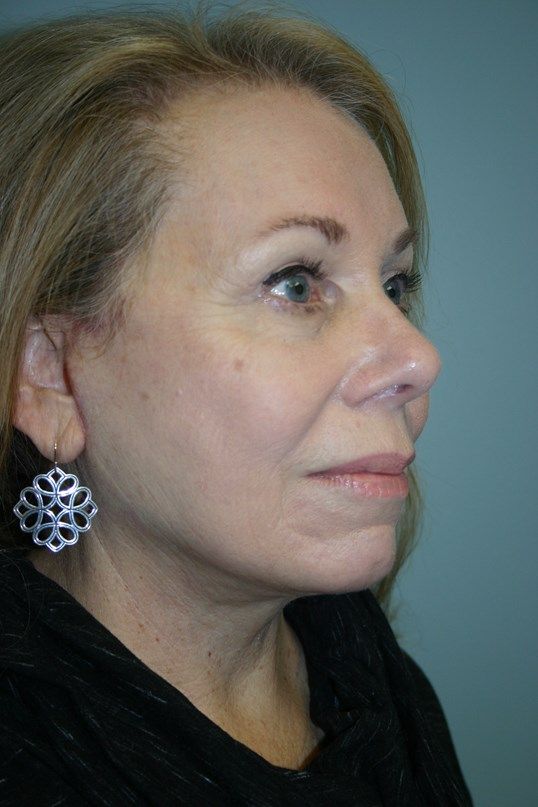 Face Lift Before & After