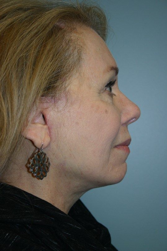 Face Lift Before & After