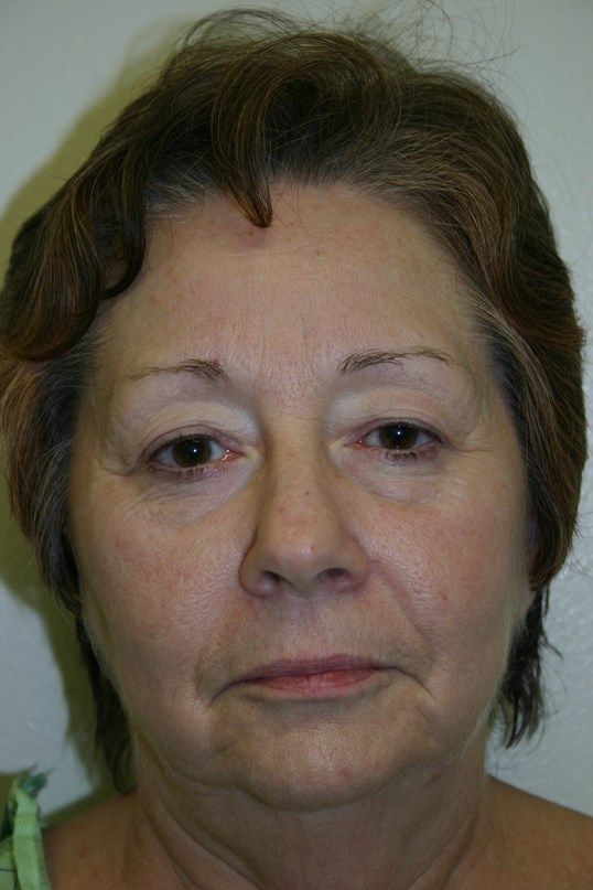 Face Lift Before & After