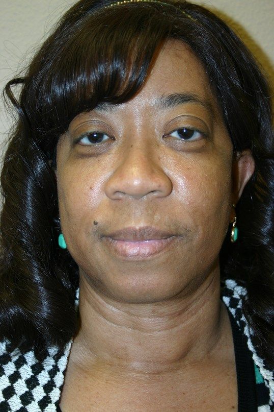 Face Lift Before & After