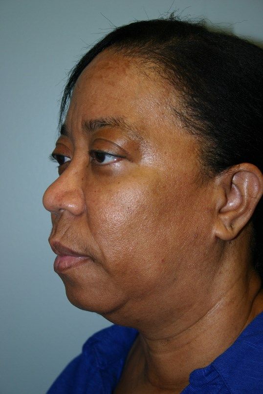 Face Lift Before & After