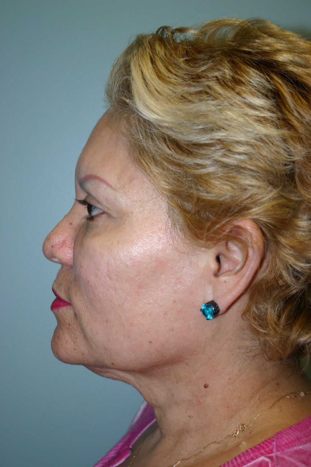 Face Lift Before & After