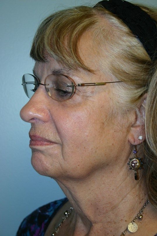 Face Lift Before & After