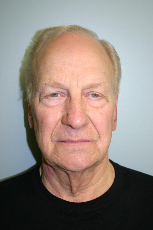 Face Lift Before & After