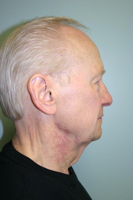 Face Lift Before & After