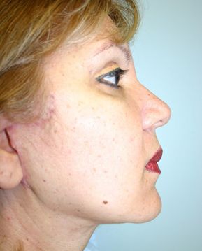 Face Lift Before & After