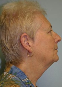 Face Lift Before & After