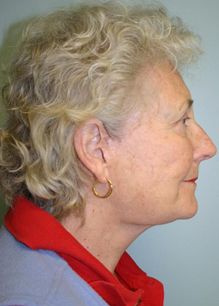 Face Lift Before & After