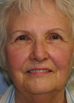 Face Lift Before & After