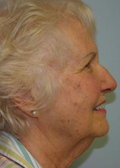 Face Lift Before & After