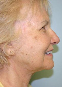 Face Lift Before & After