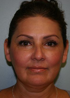 Face Lift Before & After