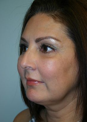 Face Lift Before & After