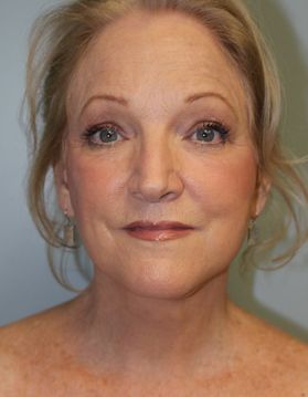 Face Lift Before & After