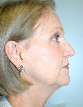 Face Lift Before & After