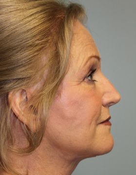 Face Lift Before & After