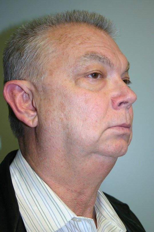 Face Lift Before & After