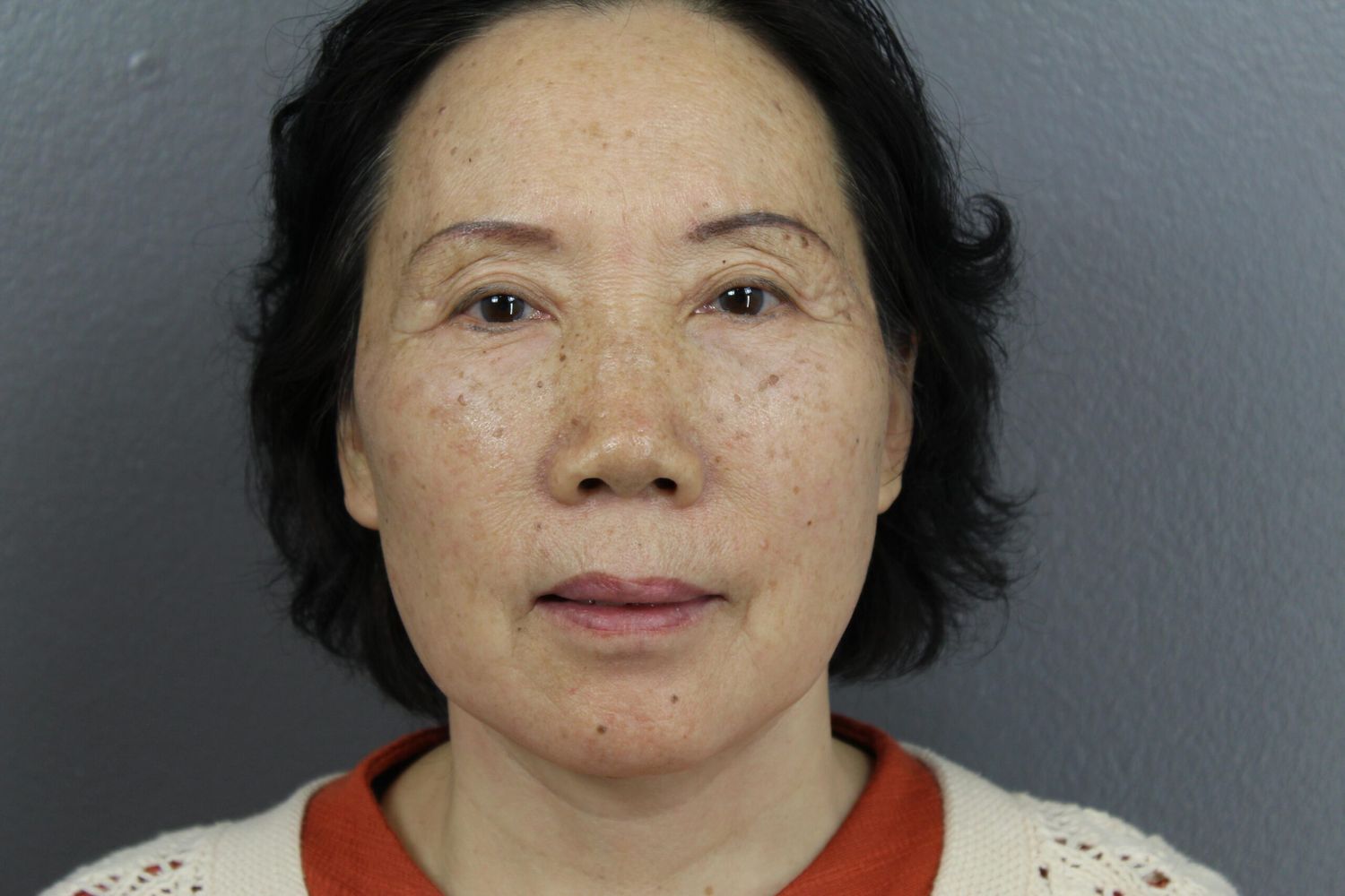 Face Lift Before & After