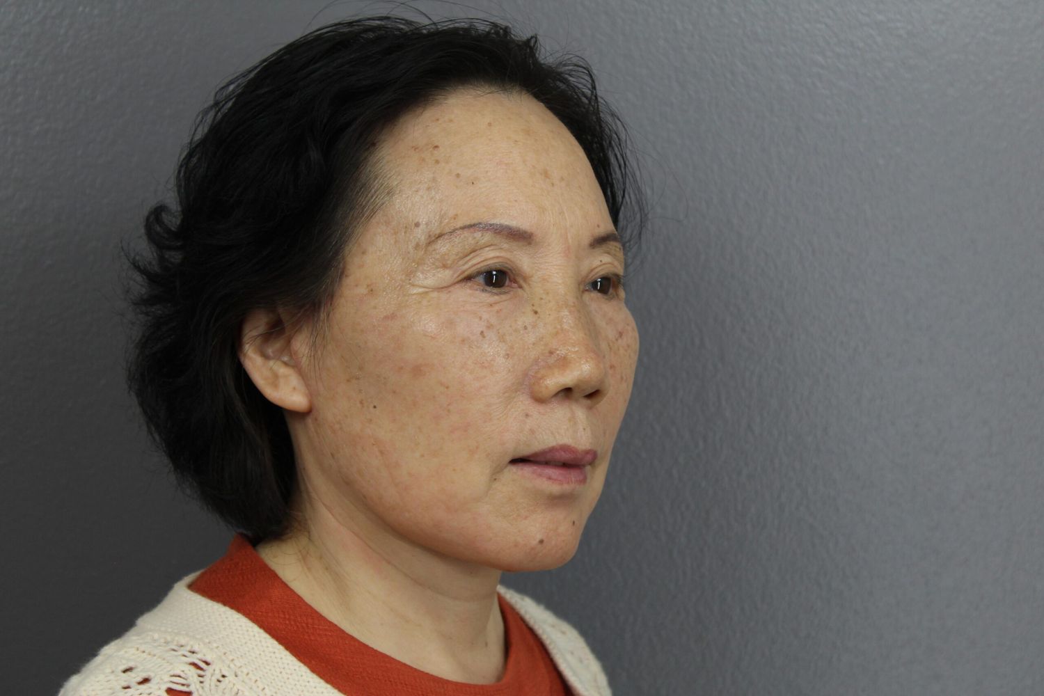 Face Lift Before & After