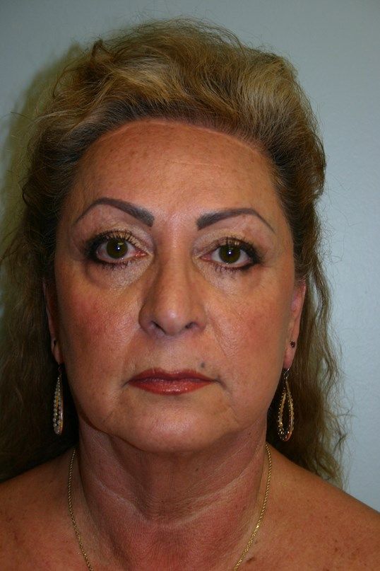 Face Lift Before & After